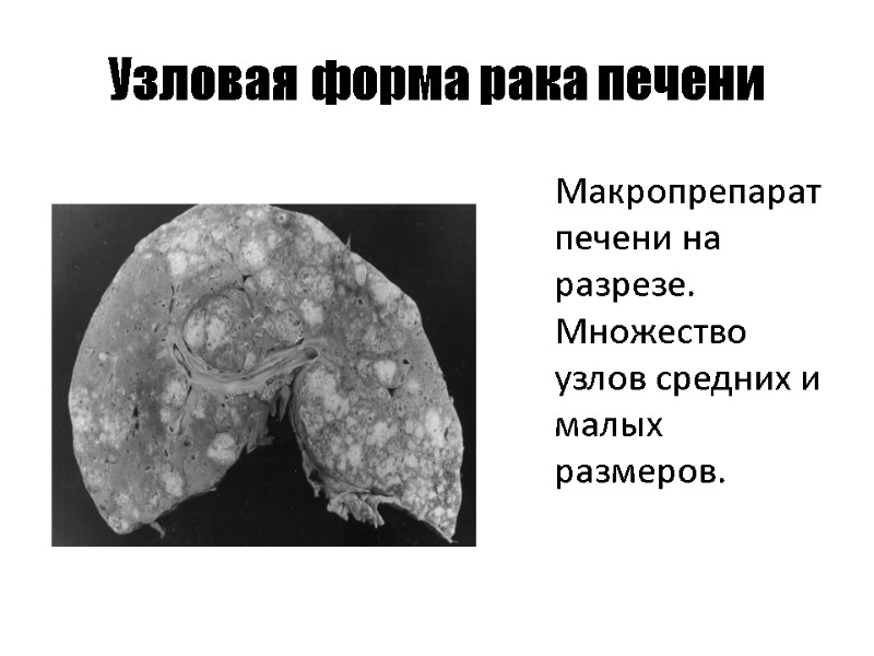 Узловая форма рака печени  Макропрепарат печени на разрезе. Множество узлов средних и малых